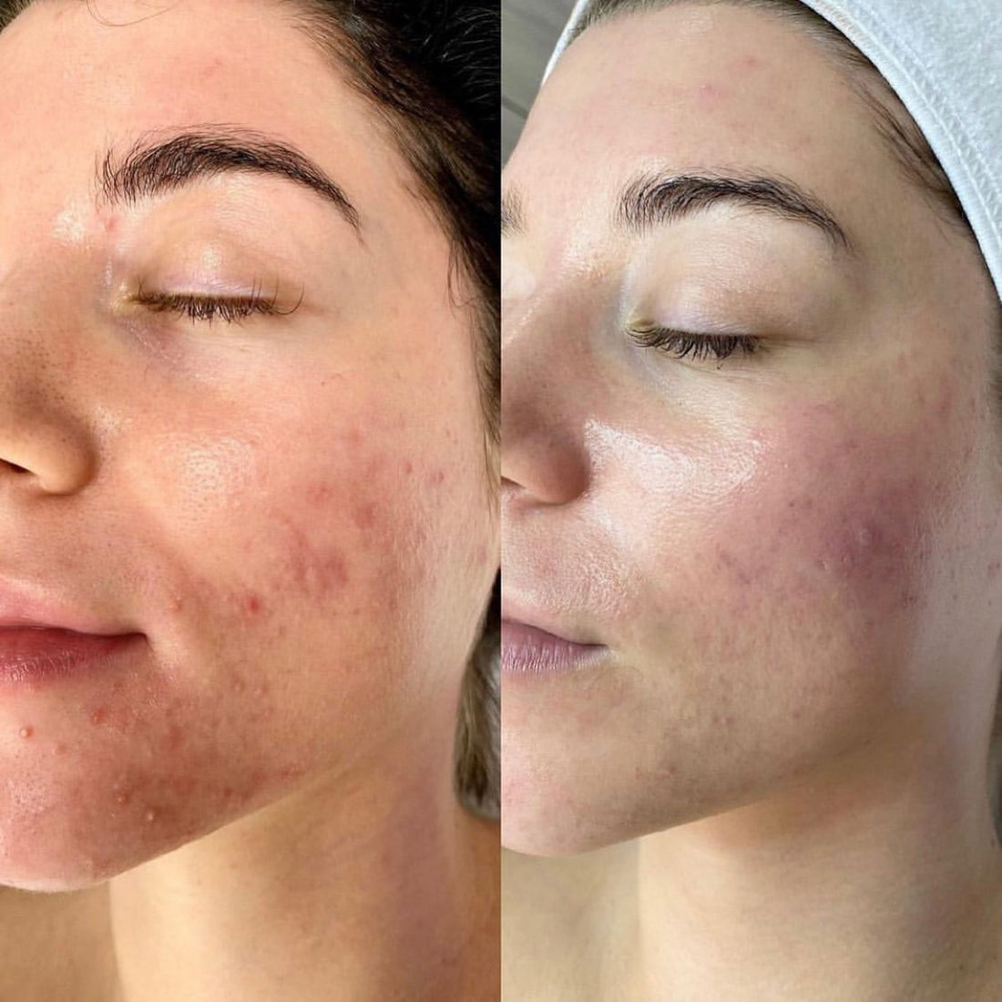 HydraFacial Behandlung Basel – Vortex-Technologie für strahlende Haut bei TREMP Plastic Surgery