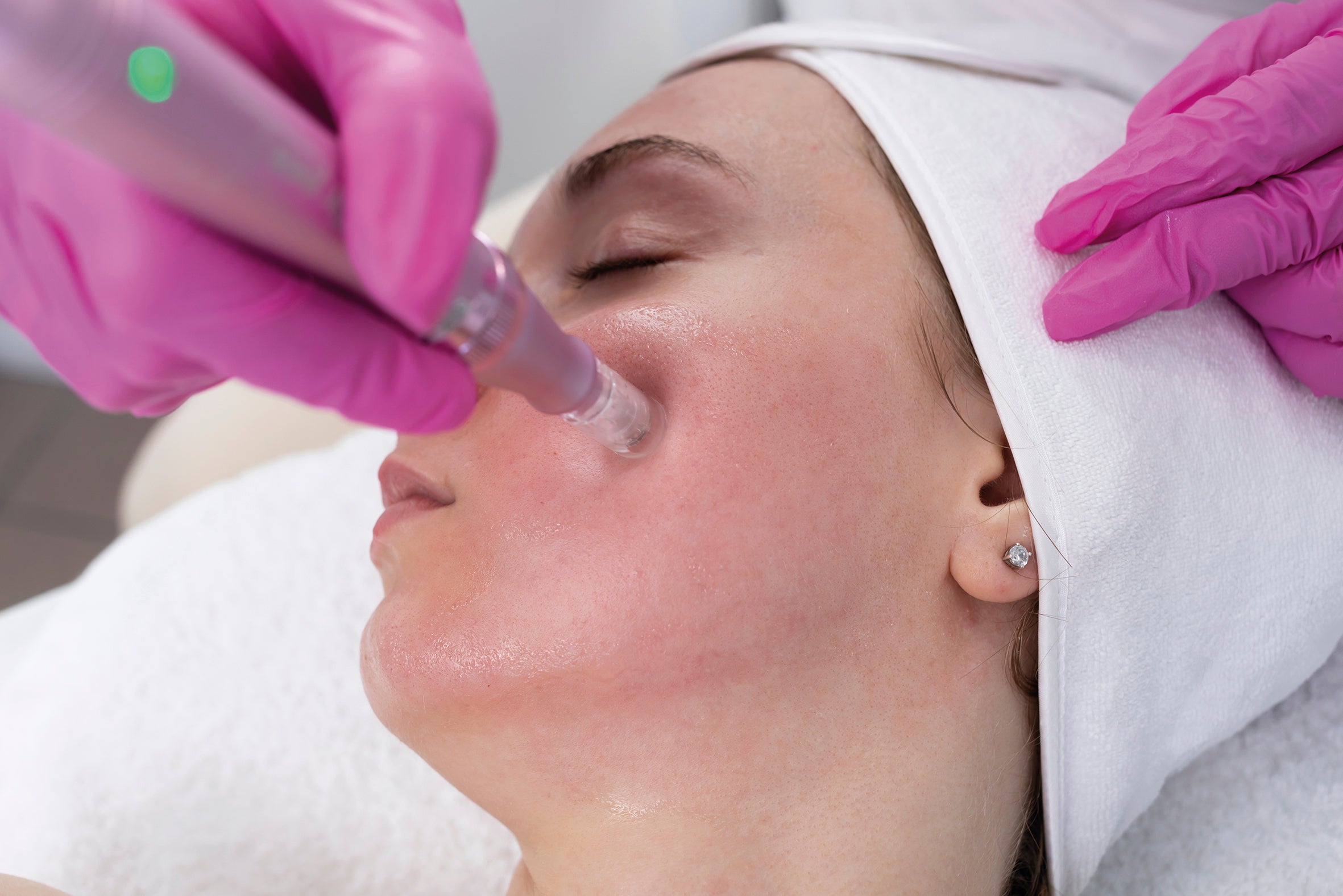 Dermapen 4™ Microneedling Zürich – Kollagenaufbau, Narben & Hauterneuerung